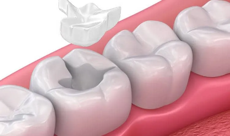 Ilustración de una incrustación dental sobre un molar, odontología conservadora en la Clínica Dental Lijó