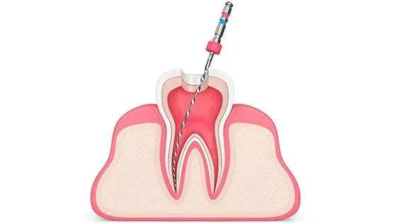 Ilustración de un tratamiento de endodoncia en un diente, Clínica Dental Lijó en Vigo