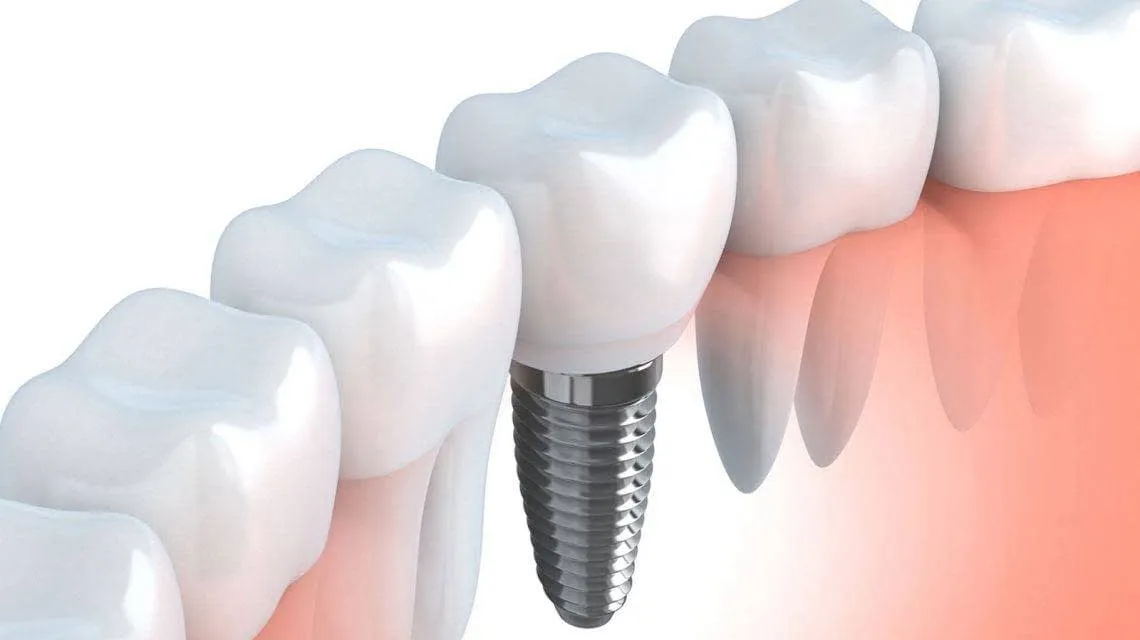Ilustración de un implante dental integrado en la encía, tratamiento de la Clínica Dental Lijó