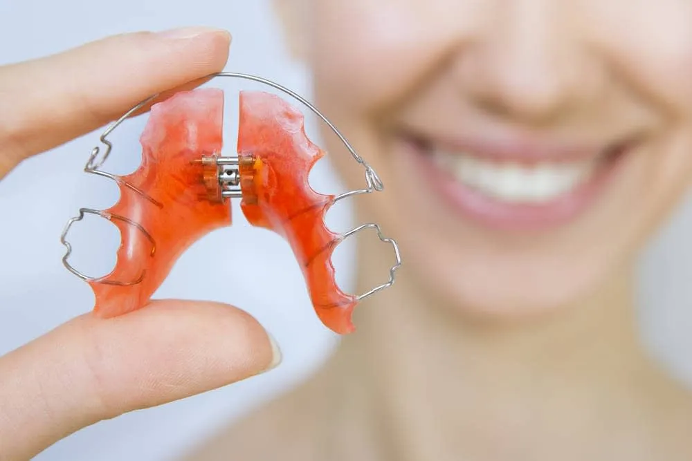 Aparato de ortodoncia removible junto a una sonrisa, tratamiento de la Clínica Dental Lijó