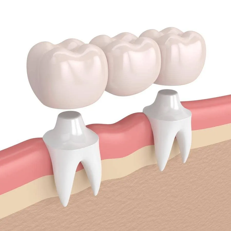 Ilustración de un puente dental fijo, prótesis dental en la Clínica Dental Lijó